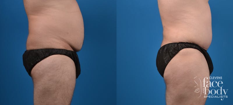 Hidden Tummy Tuck Before & After Gallery - Patient 198245 - Image 3