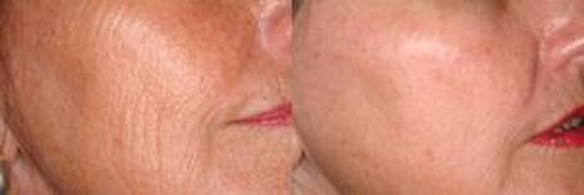 Skin Resurfacing Before & After Gallery - Patient 122406595 - Image 1
