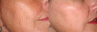 Skin Resurfacing Before & After Gallery - Patient 122406595 - Image 1