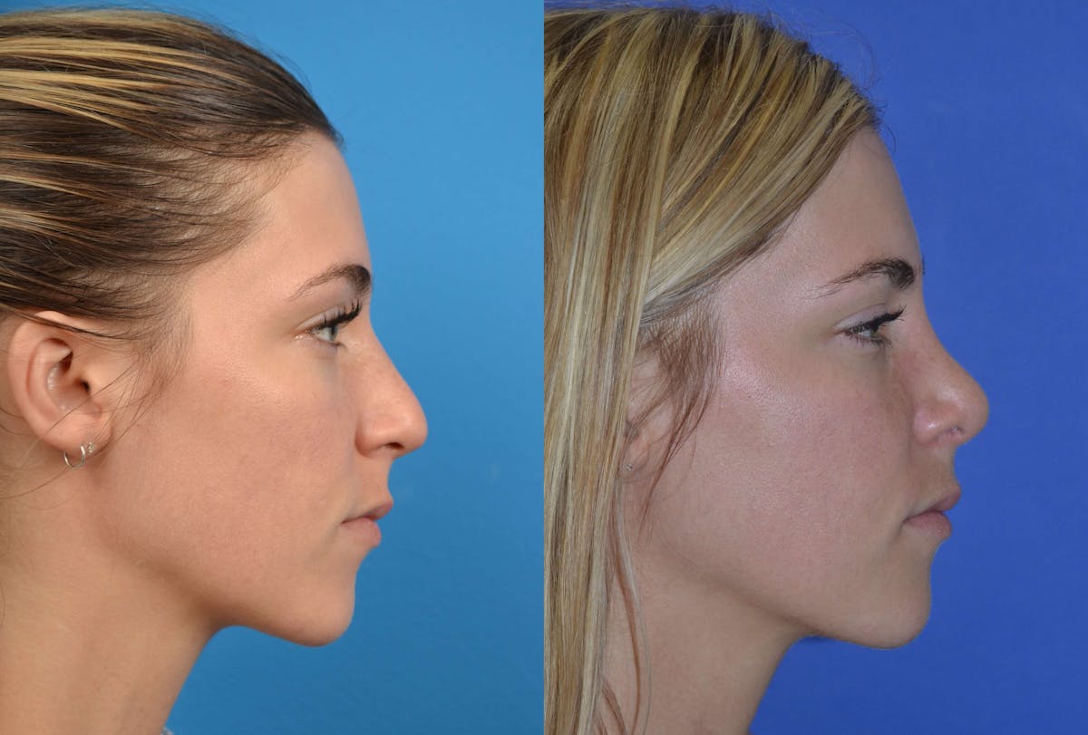 Rhinoplasty Before & After Gallery - Patient 122406606 - Image 1