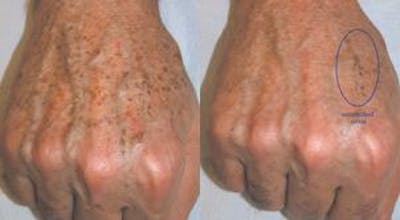Skin Resurfacing Before & After Gallery - Patient 122406597 - Image 1