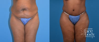 Hidden Tummy Tuck Before & After Gallery - Patient 142892 - Image 1