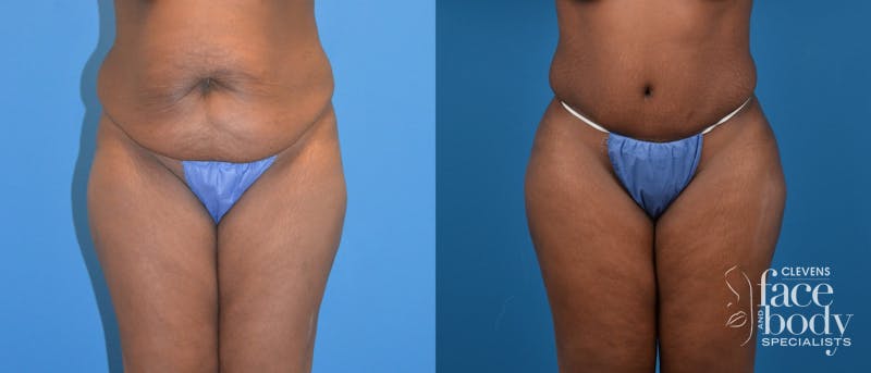 Hidden Tummy Tuck Before & After Gallery - Patient 142892 - Image 1