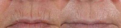 Skin Resurfacing Before & After Gallery - Patient 122406598 - Image 1