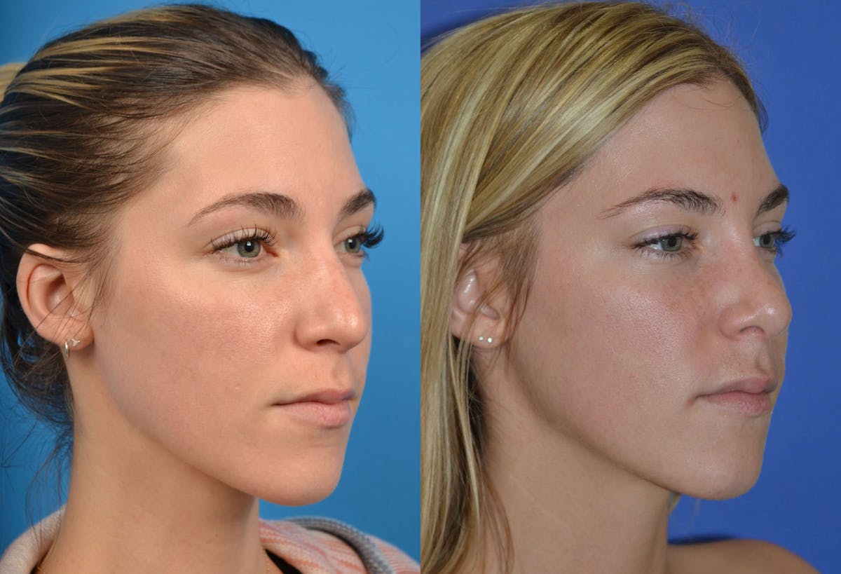 Rhinoplasty Before & After Gallery - Patient 122406606 - Image 2