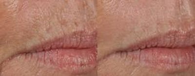 Skin Resurfacing Before & After Gallery - Patient 122406599 - Image 1