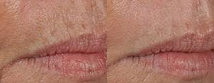 Skin Resurfacing Before & After Gallery - Patient 122406599 - Image 1