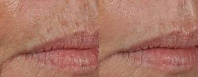 Skin Resurfacing Before & After Gallery - Patient 122406599 - Image 1