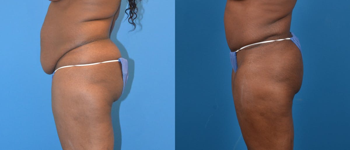 Hidden Tummy Tuck Before & After Gallery - Patient 142892 - Image 2