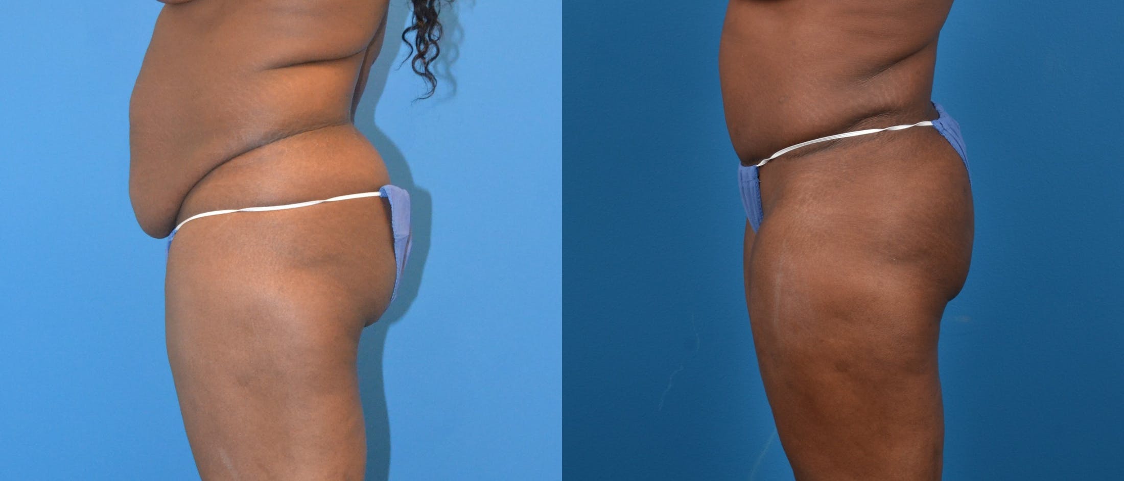 Tummy Tuck Before & After Gallery - Patient 122406602 - Image 2