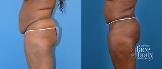 Hidden Tummy Tuck Before & After Gallery - Patient 142892 - Image 2