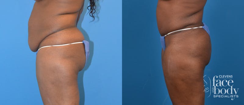 Hidden Tummy Tuck Before & After Gallery - Patient 142892 - Image 2