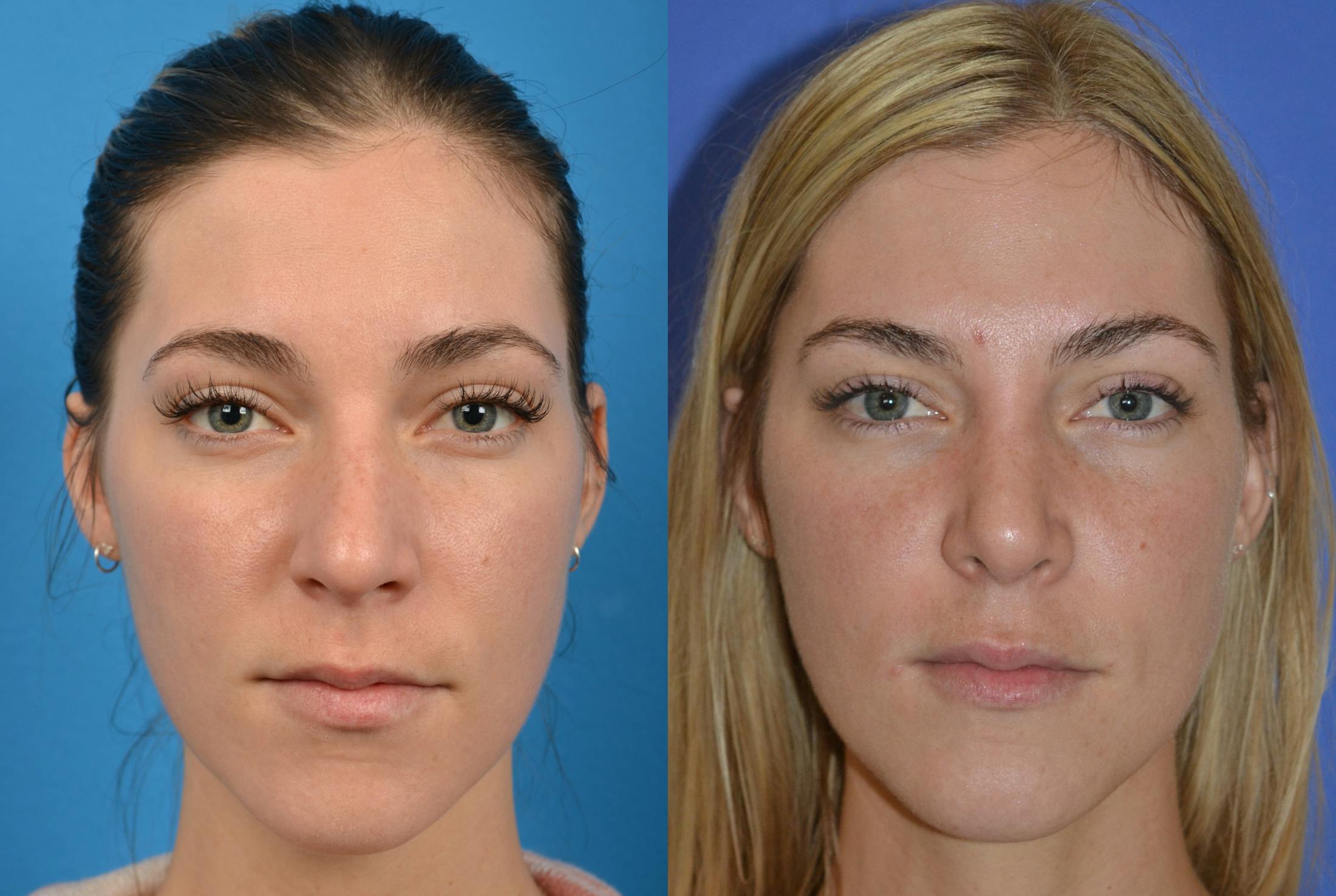 Rhinoplasty Before & After Gallery - Patient 122406606 - Image 3