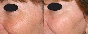 Skin Resurfacing Before & After Gallery - Patient 122406600 - Image 1