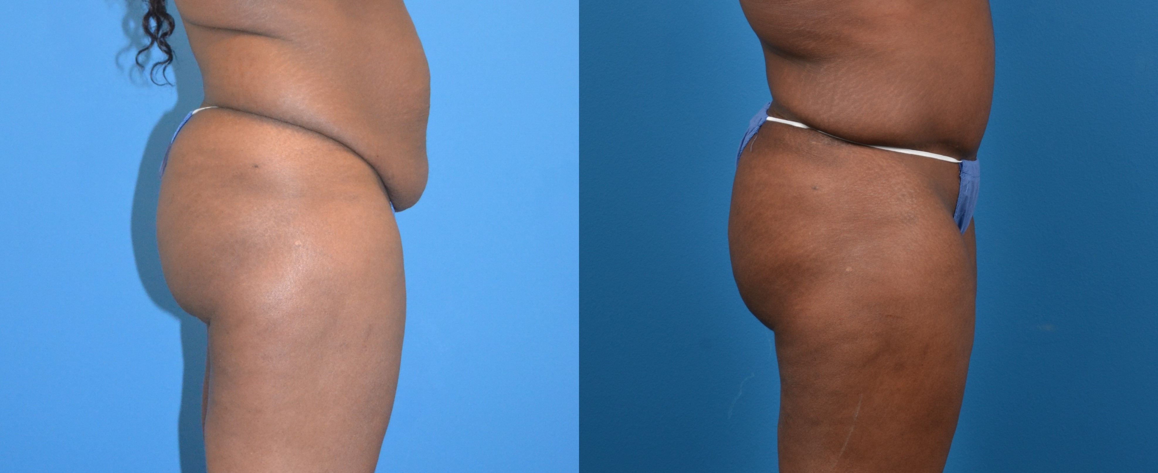Hidden Tummy Tuck Before & After Gallery - Patient 173425 - Image 3