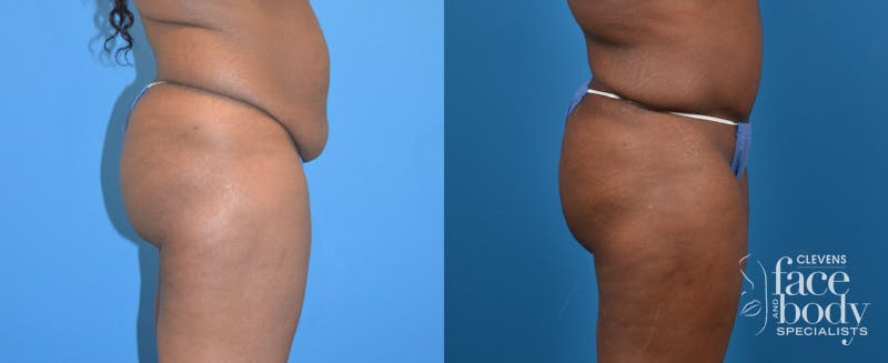 Hidden Tummy Tuck Before & After Gallery - Patient 142892 - Image 3