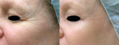 Skin Resurfacing Before & After Gallery - Patient 122406601 - Image 1