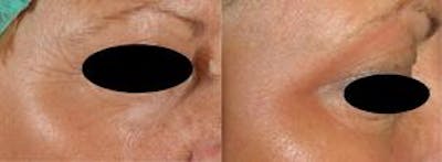 Skin Resurfacing Before & After Gallery - Patient 122406603 - Image 1