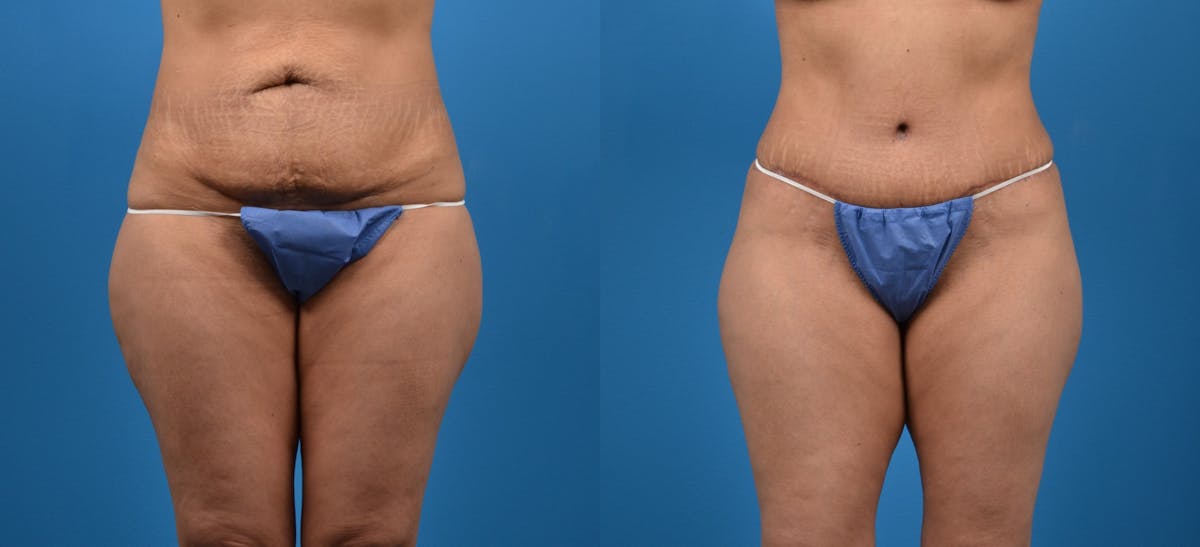 Tummy Tuck Before & After Gallery - Patient 212649 - Image 1