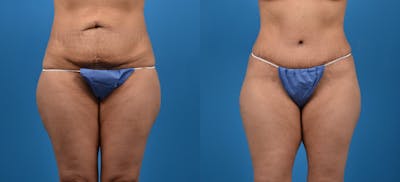 Hidden Tummy Tuck Before & After Gallery - Patient 129241 - Image 1