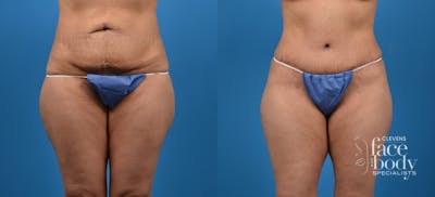 Hidden Tummy Tuck Before & After Gallery - Patient 129241 - Image 1