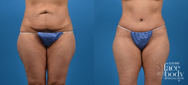 Hidden Tummy Tuck Before & After Gallery - Patient 129241 - Image 1