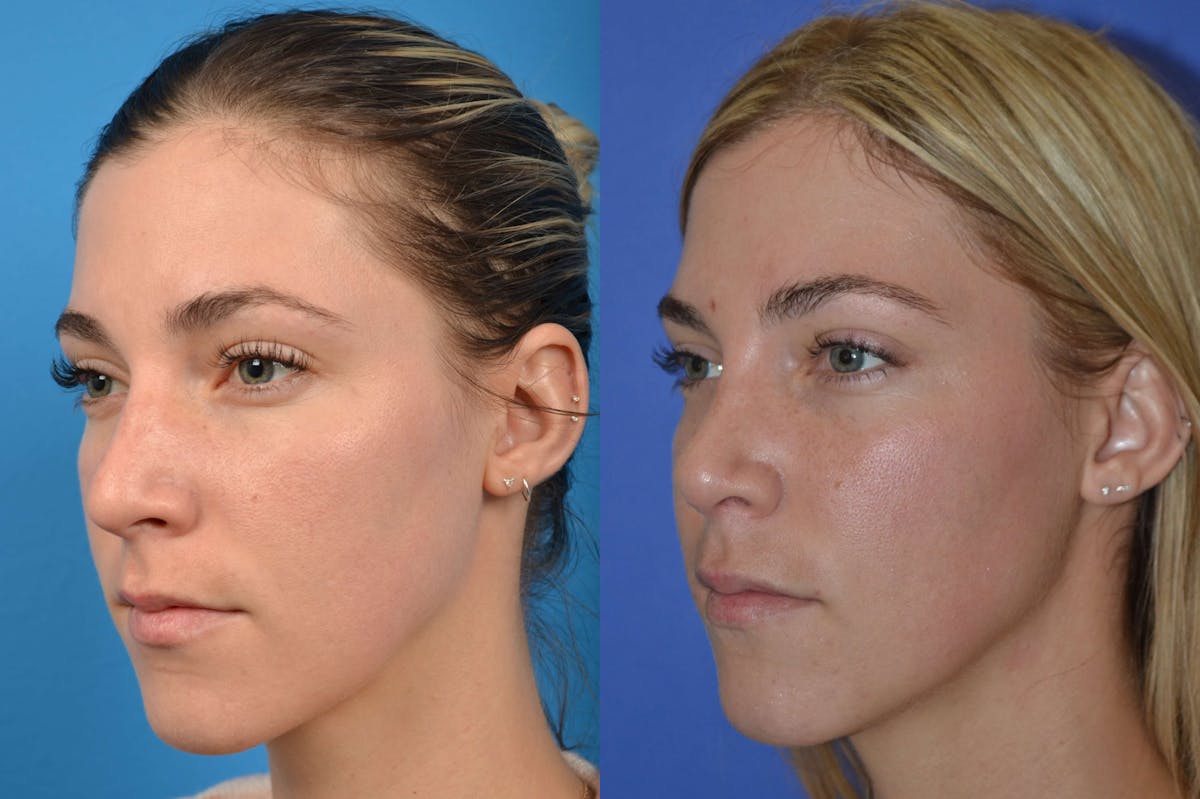 Rhinoplasty Before & After Gallery - Patient 122406606 - Image 4