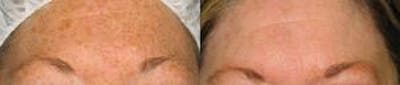 Skin Resurfacing Before & After Gallery - Patient 122406604 - Image 1