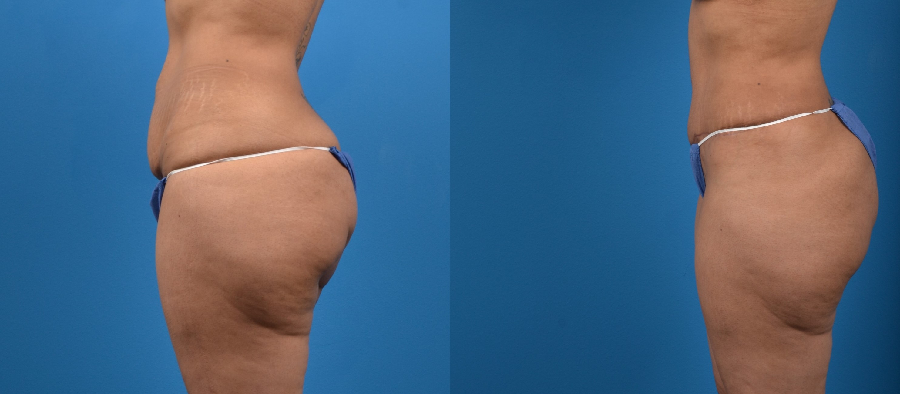 Hidden Tummy Tuck Before & After Gallery - Patient 129241 - Image 2