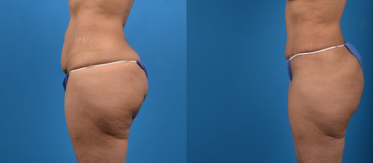 Tummy Tuck Before & After Gallery - Patient 212649 - Image 2