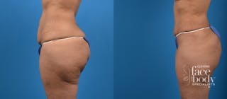 Hidden Tummy Tuck Before & After Gallery - Patient 129241 - Image 2