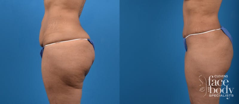 Hidden Tummy Tuck Before & After Gallery - Patient 129241 - Image 2