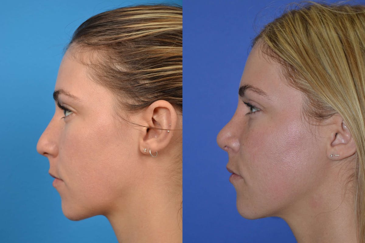 Rhinoplasty Before & After Gallery - Patient 122406606 - Image 5