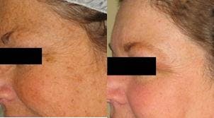 Skin Resurfacing Before & After Gallery - Patient 122406605 - Image 1