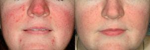 Skin Resurfacing Before & After Gallery - Patient 122406607 - Image 1
