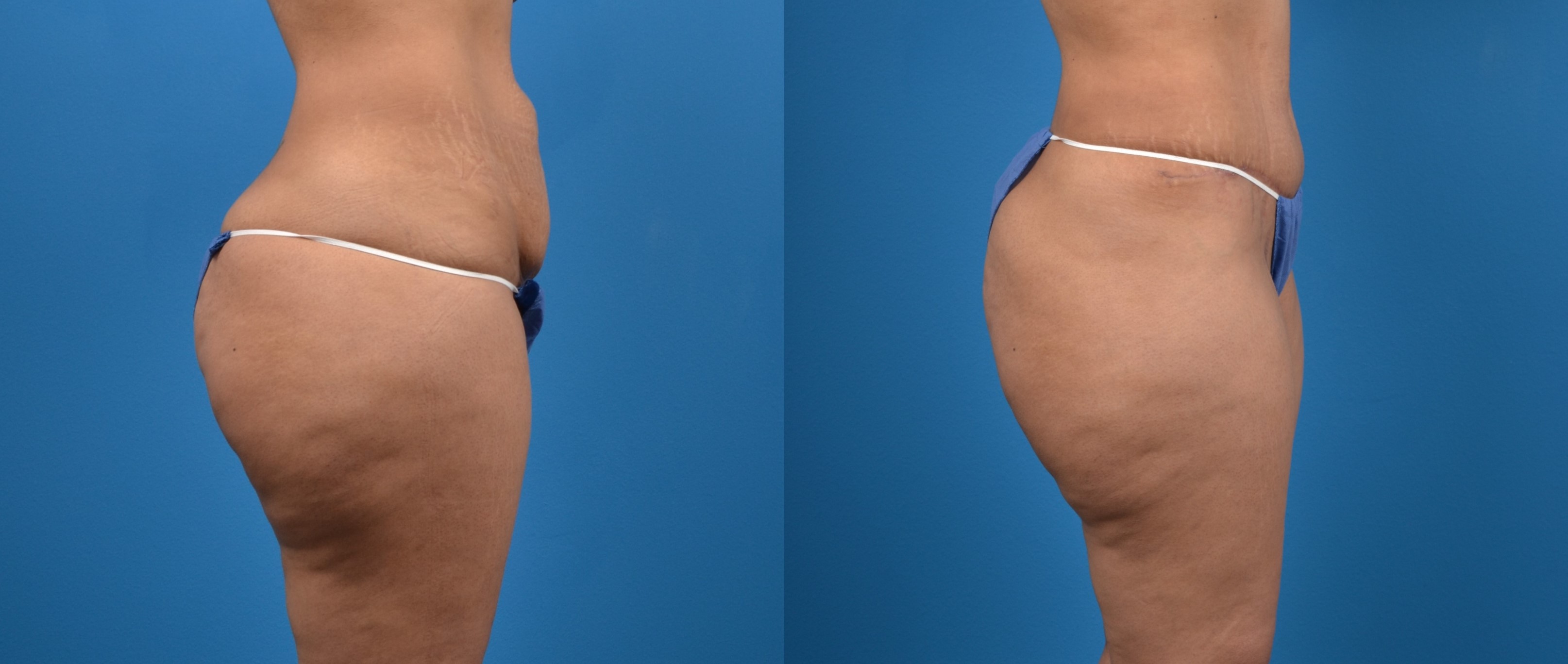 Hidden Tummy Tuck Before & After Gallery - Patient 328089 - Image 3