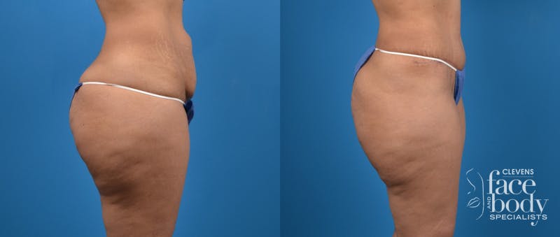 Hidden Tummy Tuck Before & After Gallery - Patient 129241 - Image 3