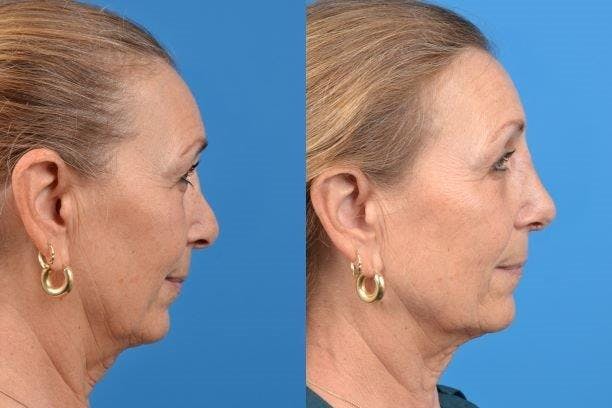 Rhinoplasty Before & After Gallery - Patient 122406614 - Image 1