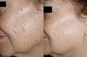 Skin Resurfacing Before & After Gallery - Patient 122406610 - Image 1