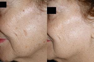 Skin Resurfacing Gallery - Patient 122406610 - Image 1