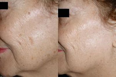 Skin Resurfacing Before & After Gallery - Patient 122406610 - Image 1
