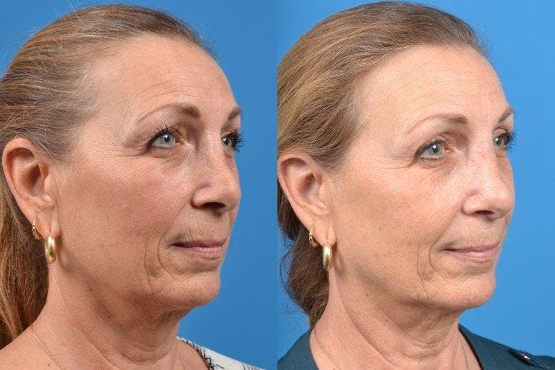 Rhinoplasty Before & After Gallery - Patient 122406614 - Image 2