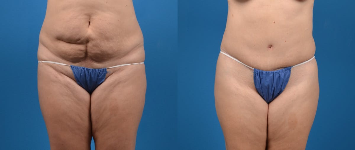 Tummy Tuck Before & After Gallery - Patient 402066 - Image 1