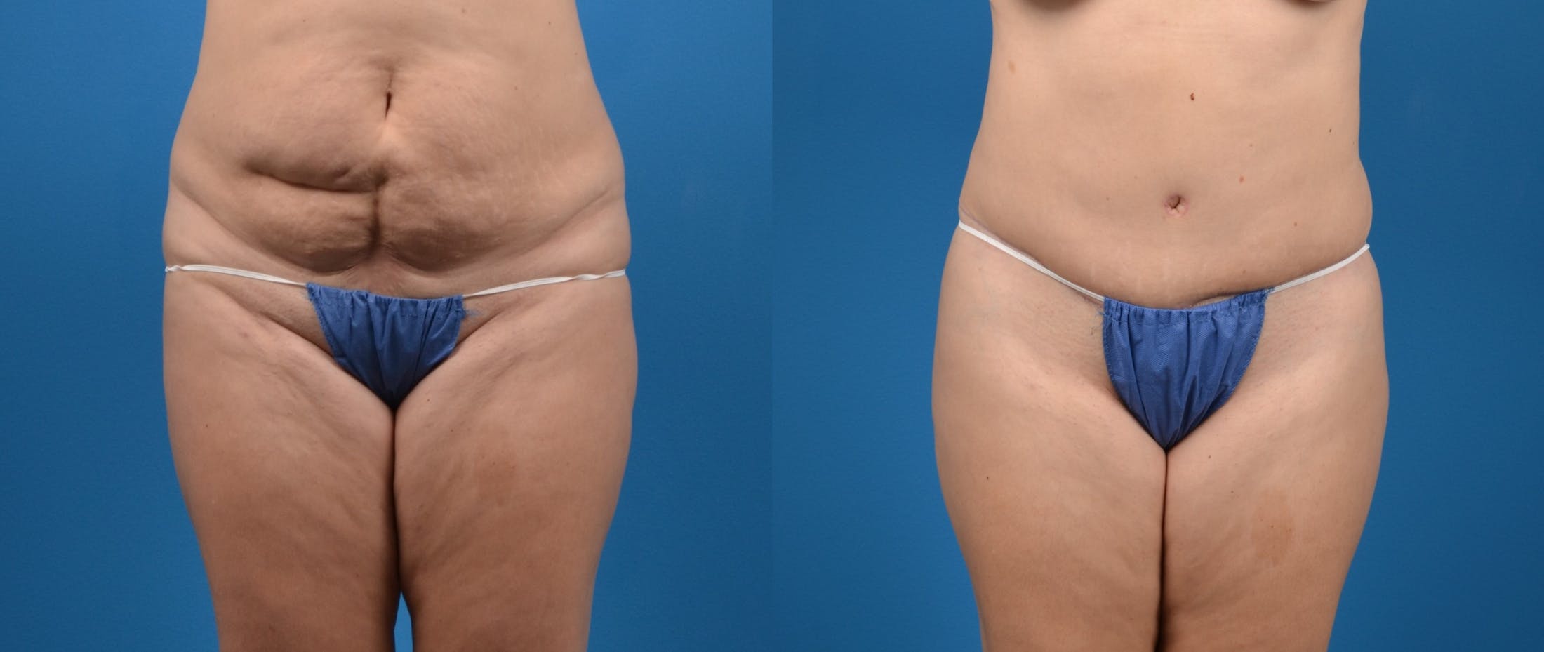 Tummy Tuck Before & After Gallery - Patient 122406616 - Image 1