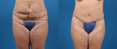 Tummy Tuck Before & After Gallery - Patient 402066 - Image 1