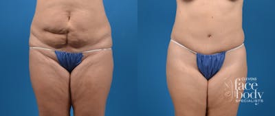Hidden Tummy Tuck Before & After Gallery - Patient 191614 - Image 1