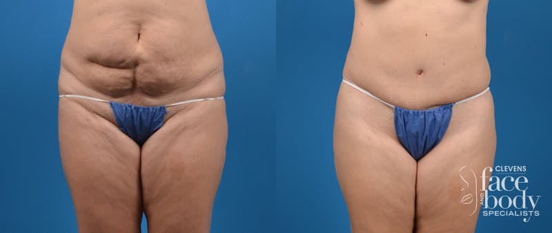 Hidden Tummy Tuck Before & After Gallery - Patient 191614 - Image 1