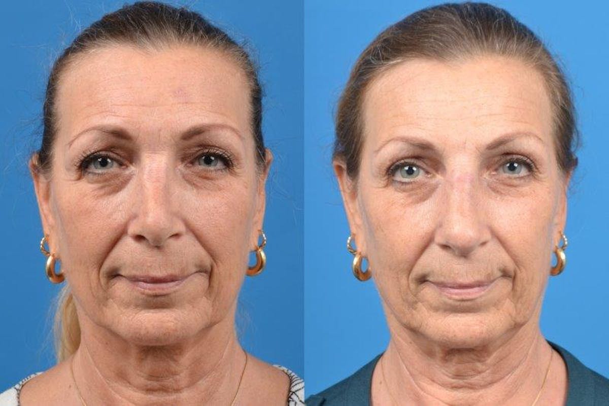 Rhinoplasty Before & After Gallery - Patient 122406614 - Image 3