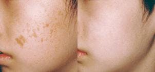 Skin Resurfacing Before & After Gallery - Patient 122406611 - Image 1