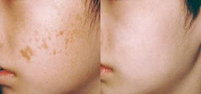 Skin Resurfacing Before & After Gallery - Patient 122406611 - Image 1